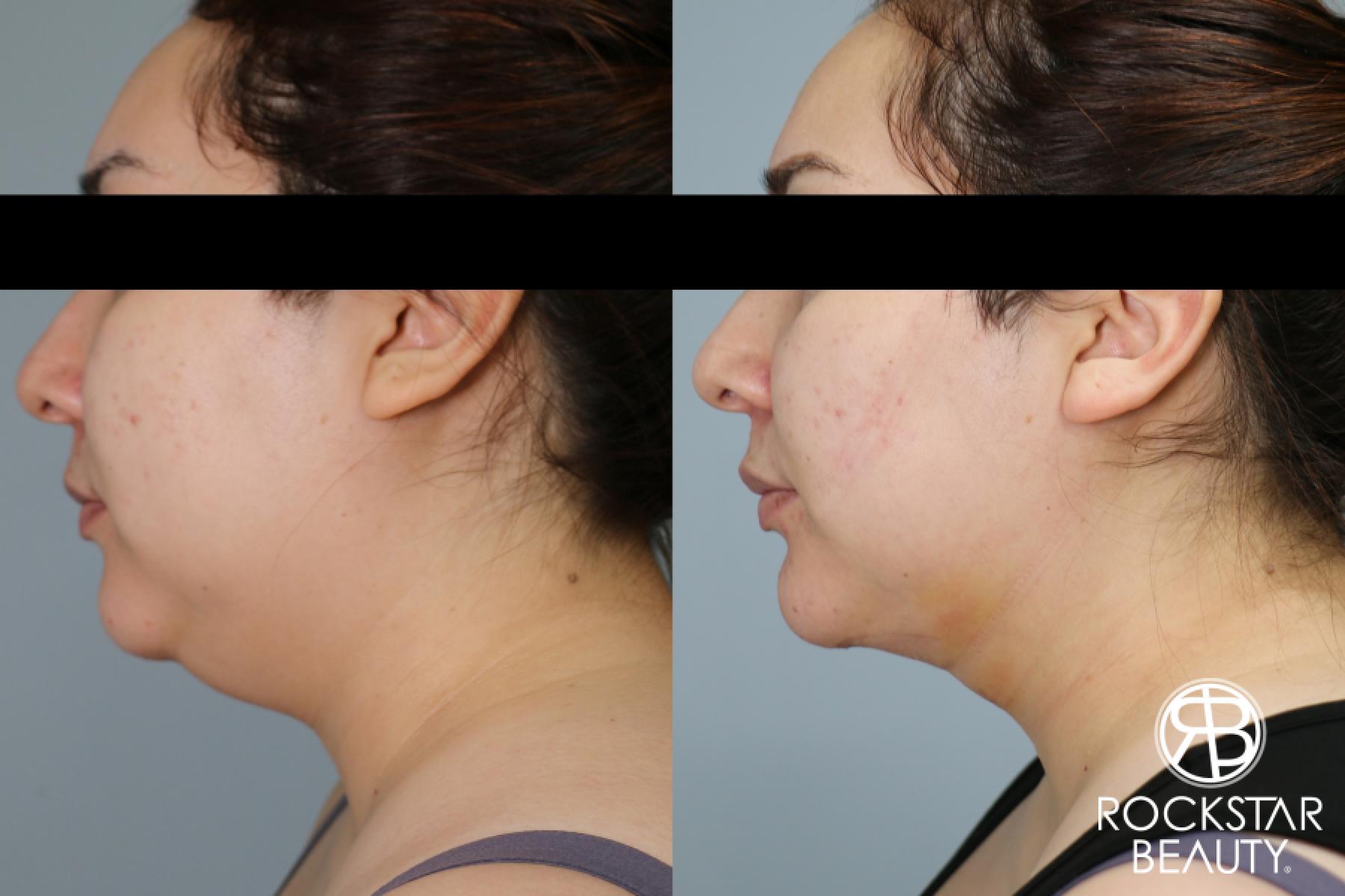 Liposuction Of The Neck: Patient 47 - Before and After 1