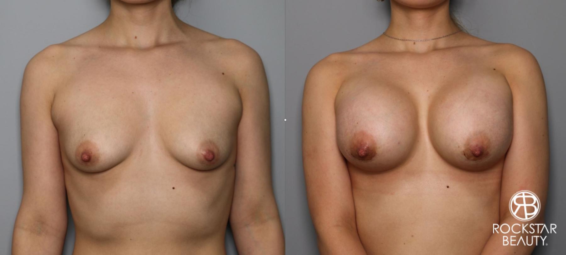 Breast Augmentation: Patient 33 - Before and After 1