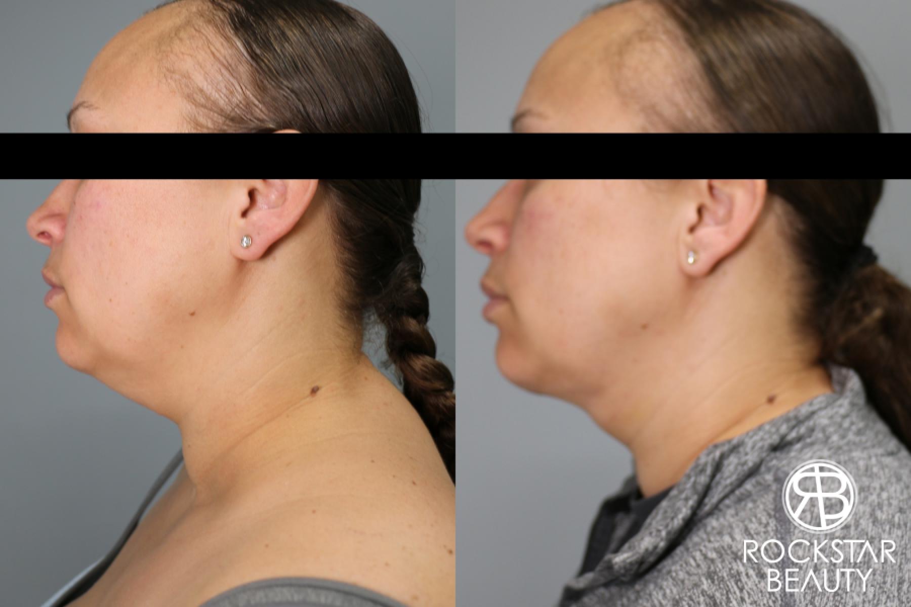 Liposuction Of The Neck: Patient 61 - Before and After 1