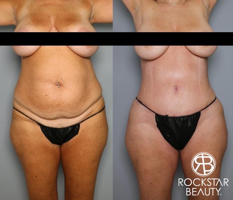 Tummy Tuck: Patient 7 - Before and After  