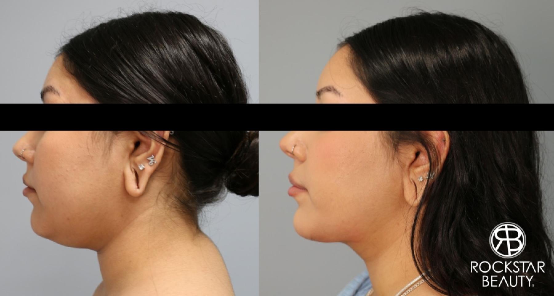 Liposuction Of The Neck: Patient 26 - Before and After 1