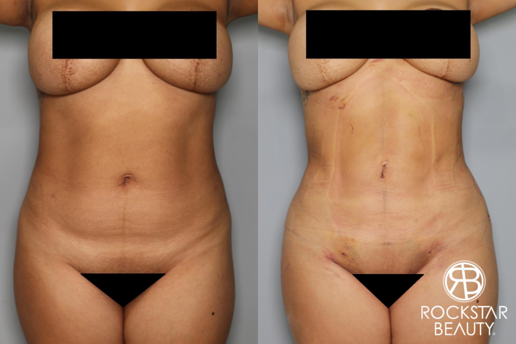 Brazilian Butt Lift: Patient 8 - Before and After 2