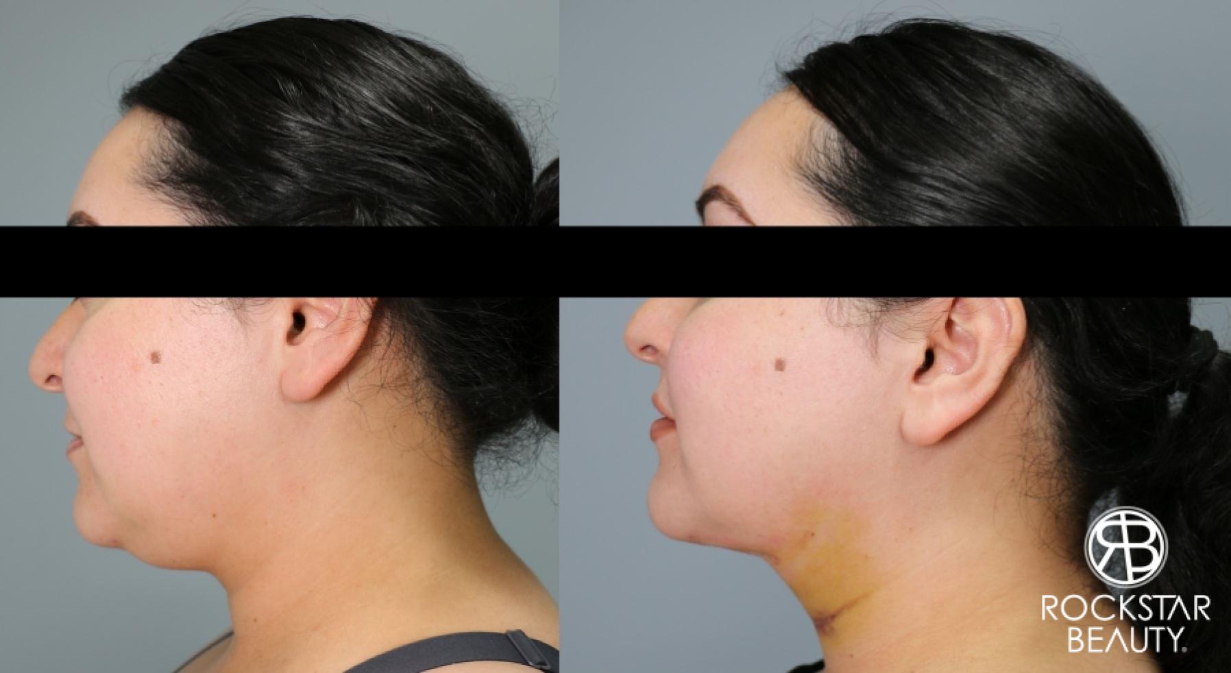 Liposuction Of The Neck: Patient 2 - Before and After  