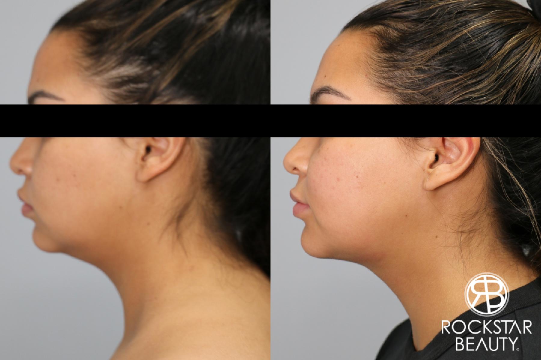 Liposuction Of The Neck: Patient 52 - Before and After 1