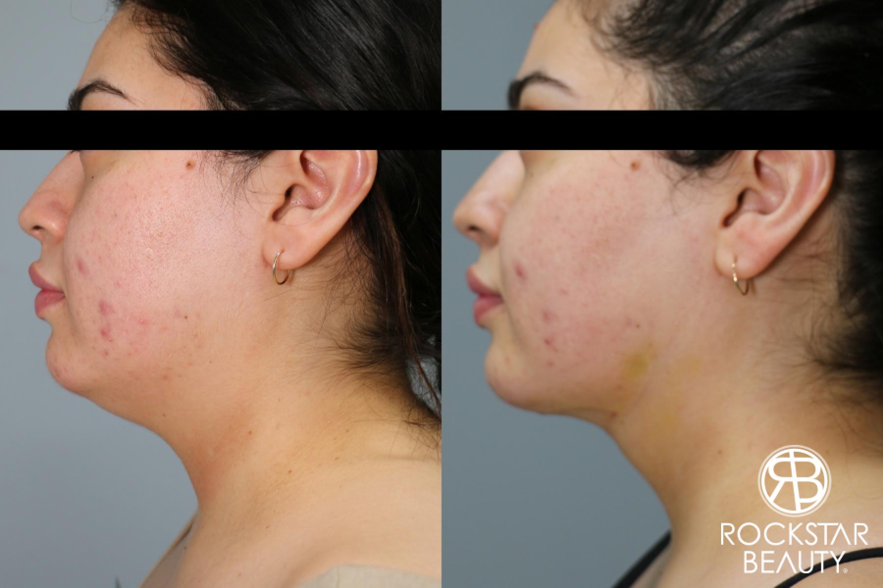 Liposuction Of The Neck: Patient 64 - Before and After 1