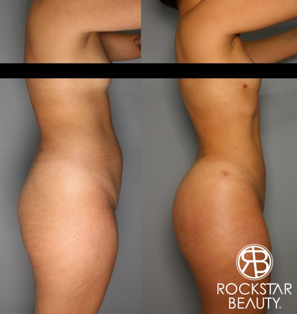 Brazilian Butt Lift: Patient 11 - Before and After 3