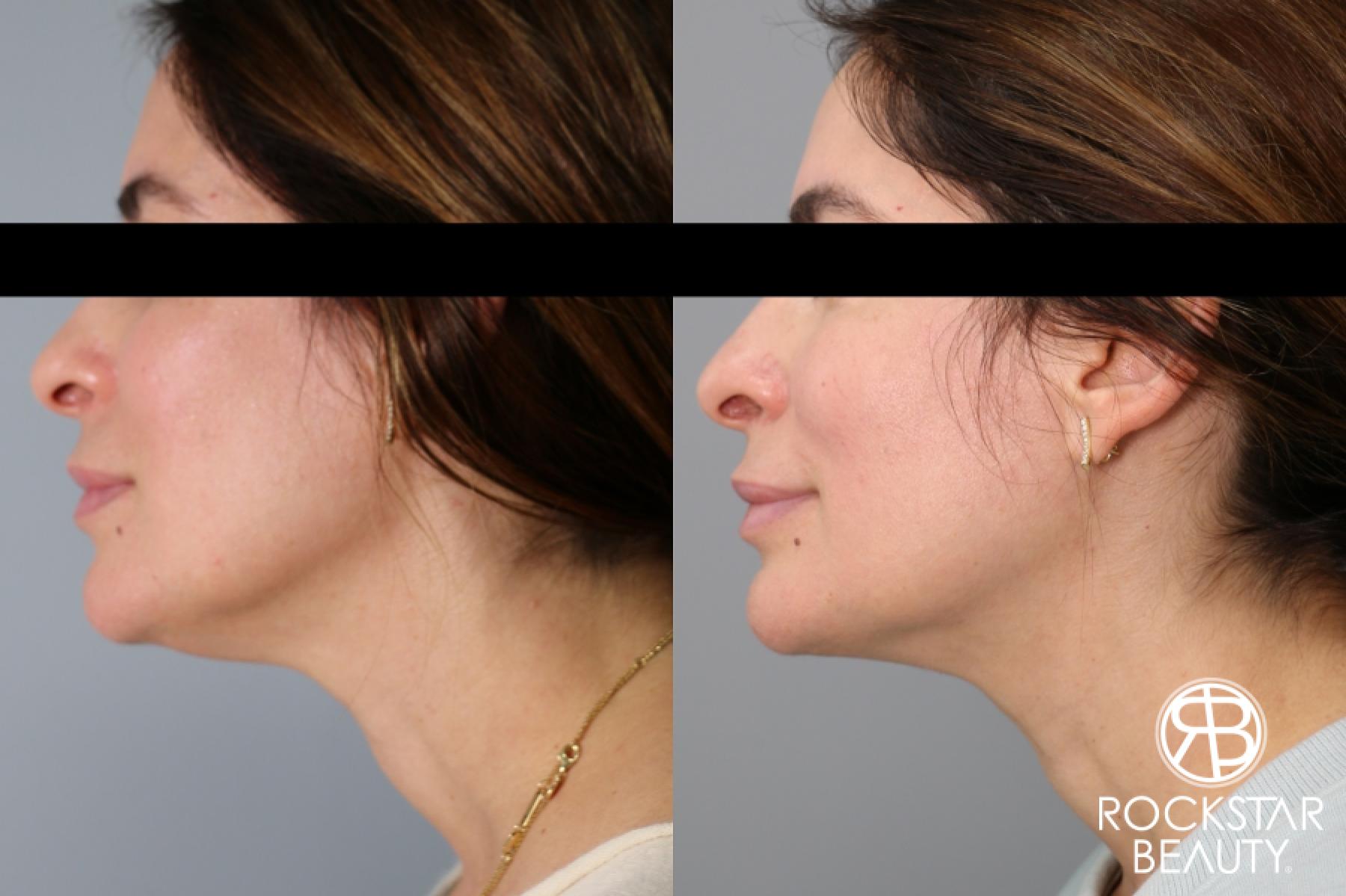 Liposuction Of The Neck: Patient 53 - Before and After 1