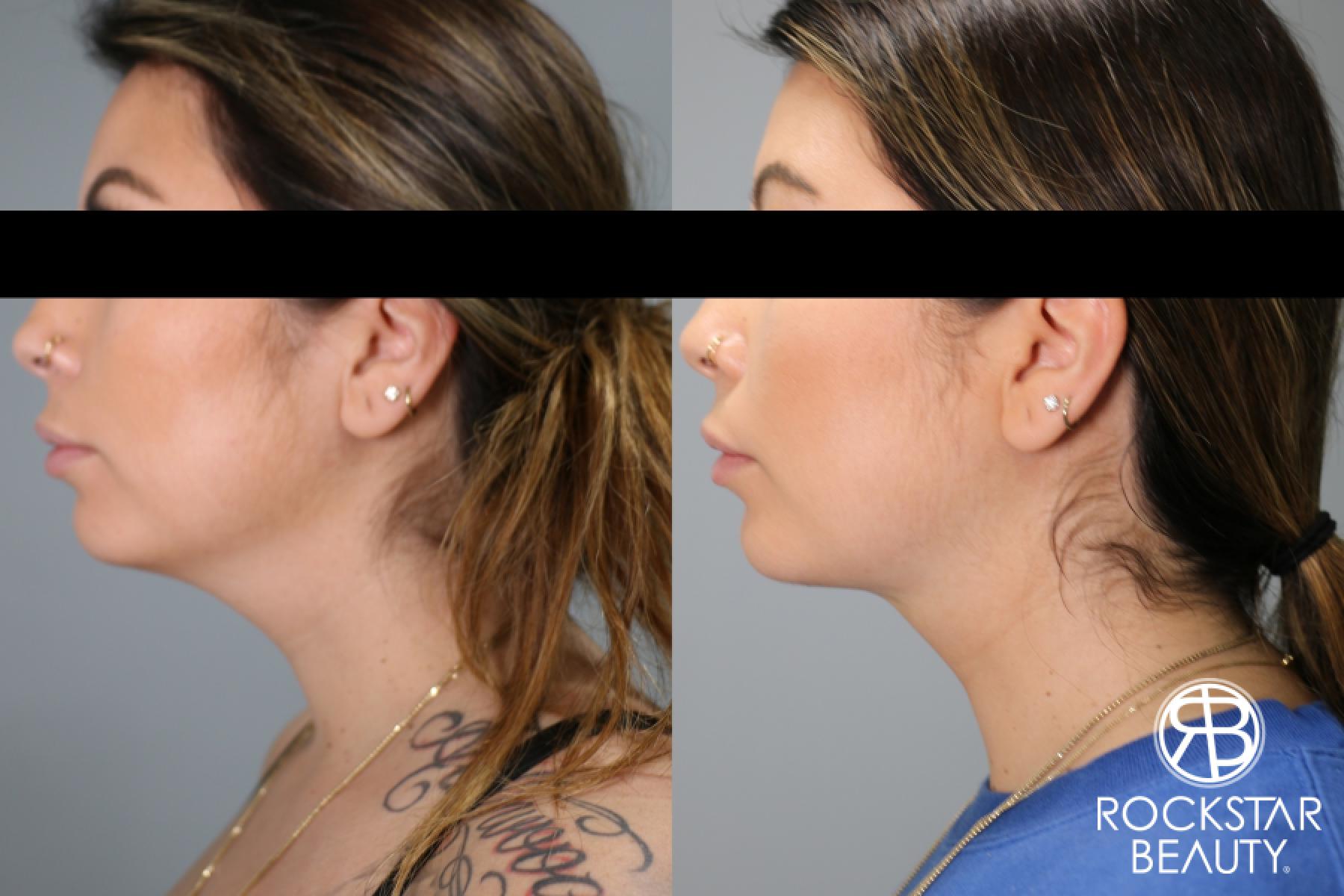 Liposuction Of The Neck: Patient 51 - Before and After 1