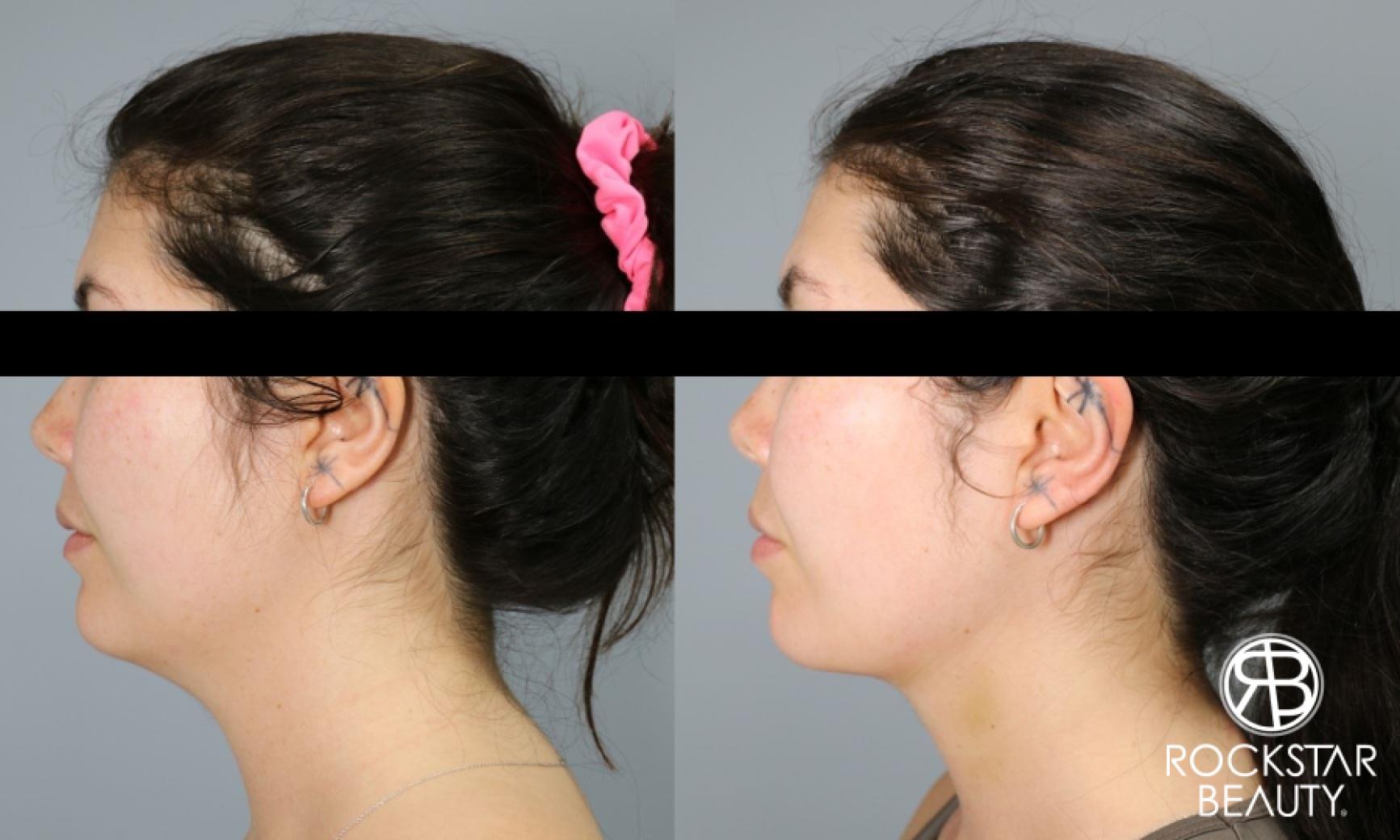 Liposuction Of The Neck: Patient 38 - Before and After 1