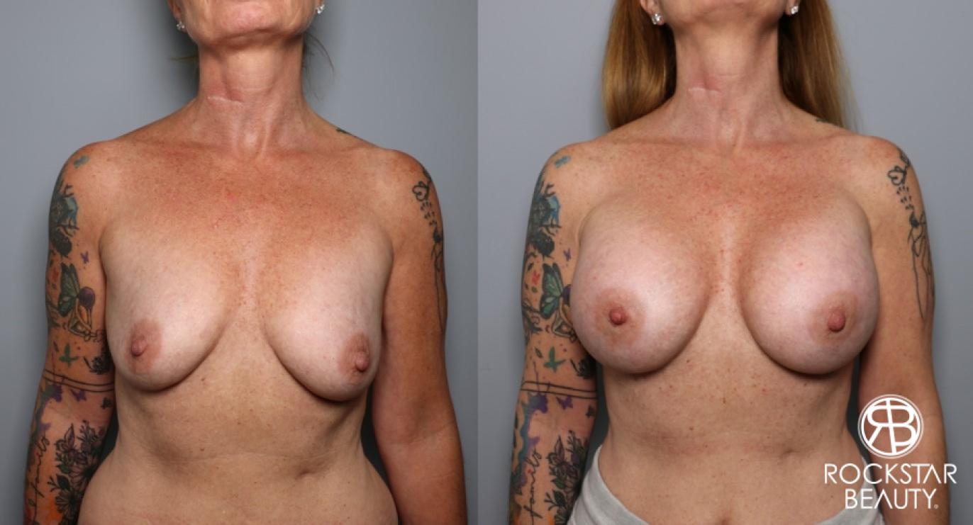 Breast Augmentation: Patient 24 - Before and After 1