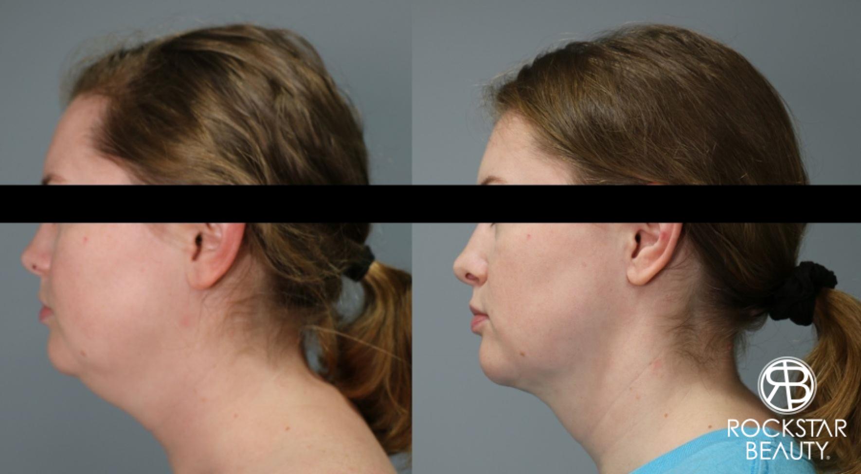 Liposuction Of The Neck: Patient 10 - Before and After 1