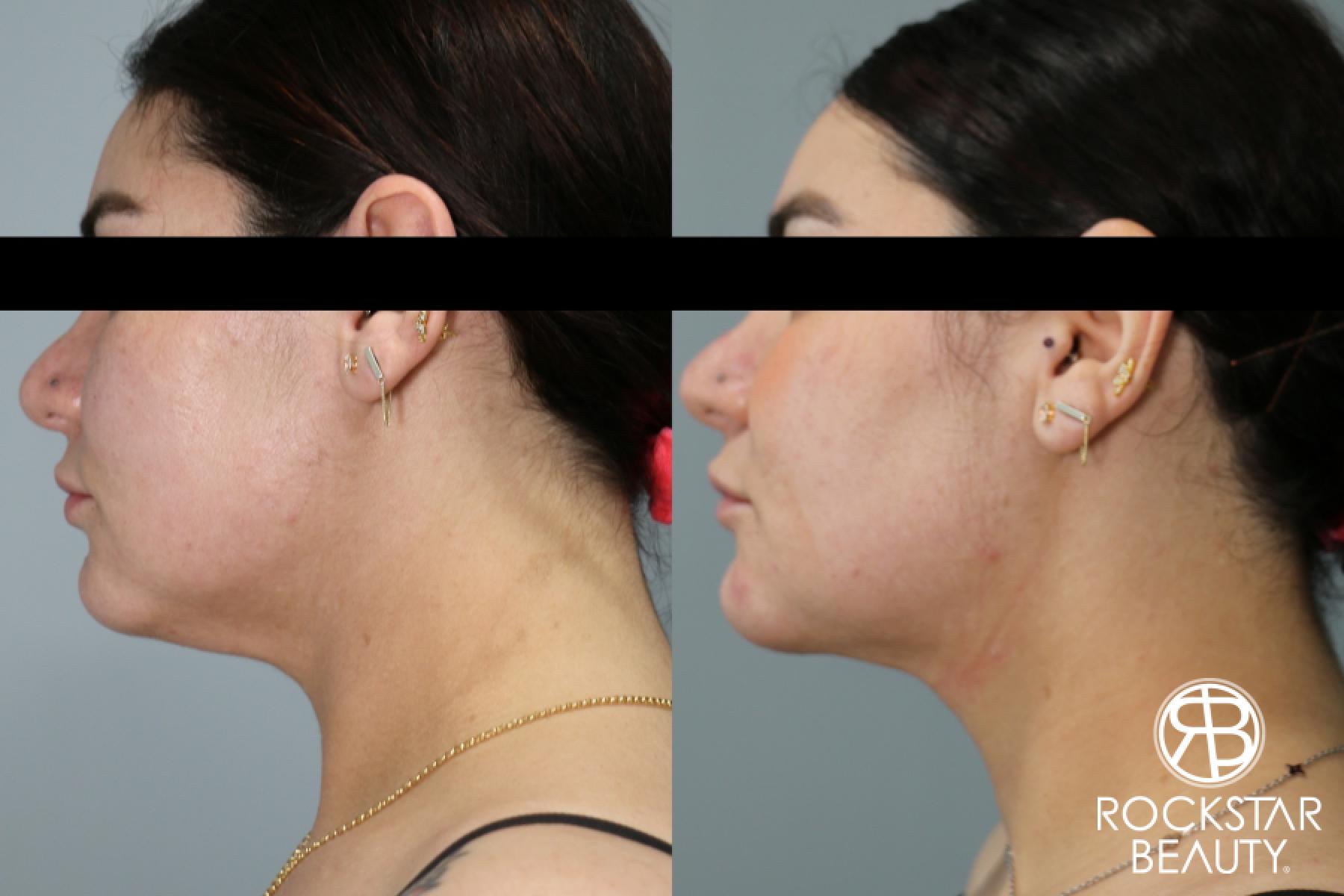 Liposuction Of The Neck: Patient 42 - Before and After 1