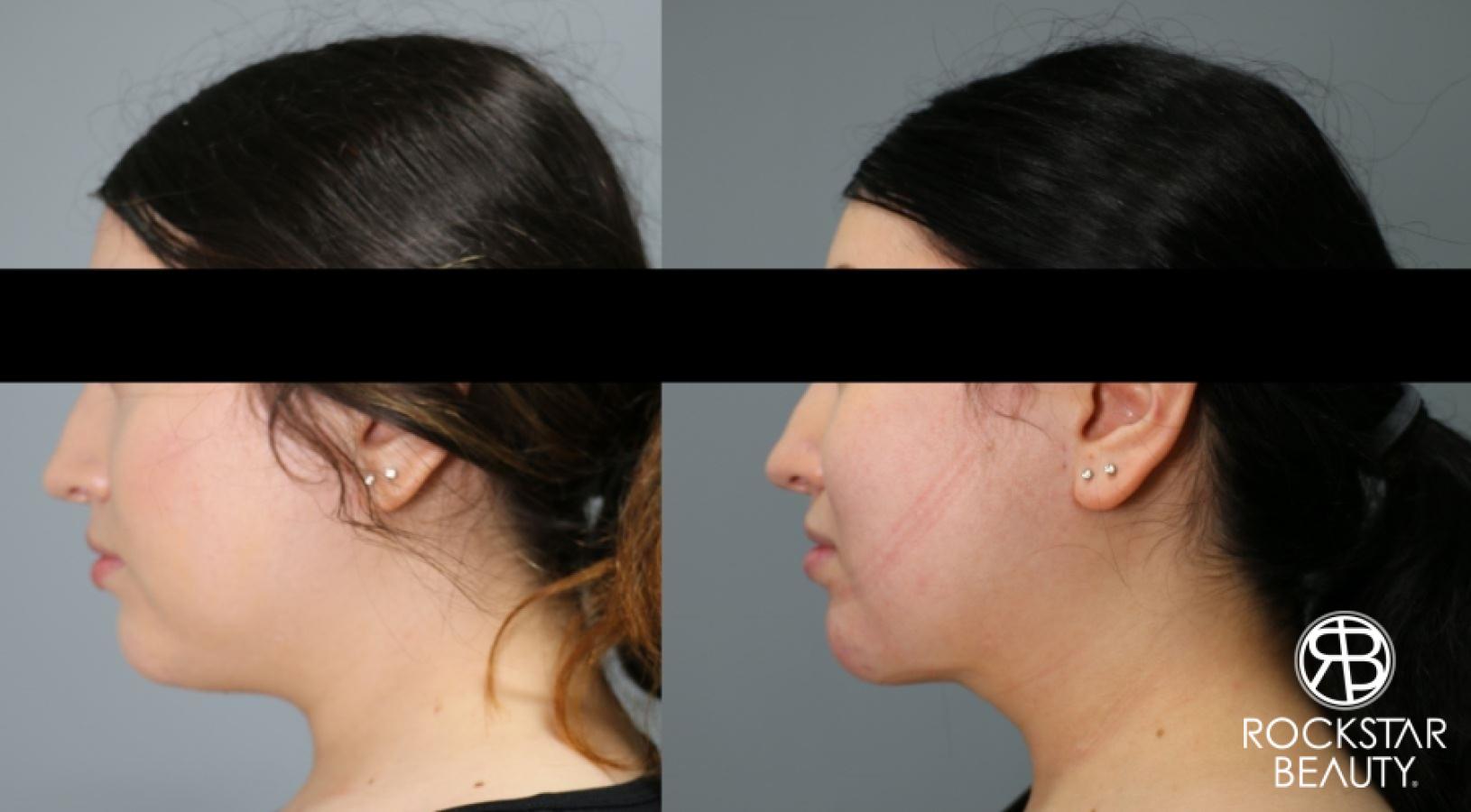 Liposuction Of The Neck: Patient 12 - Before and After 1