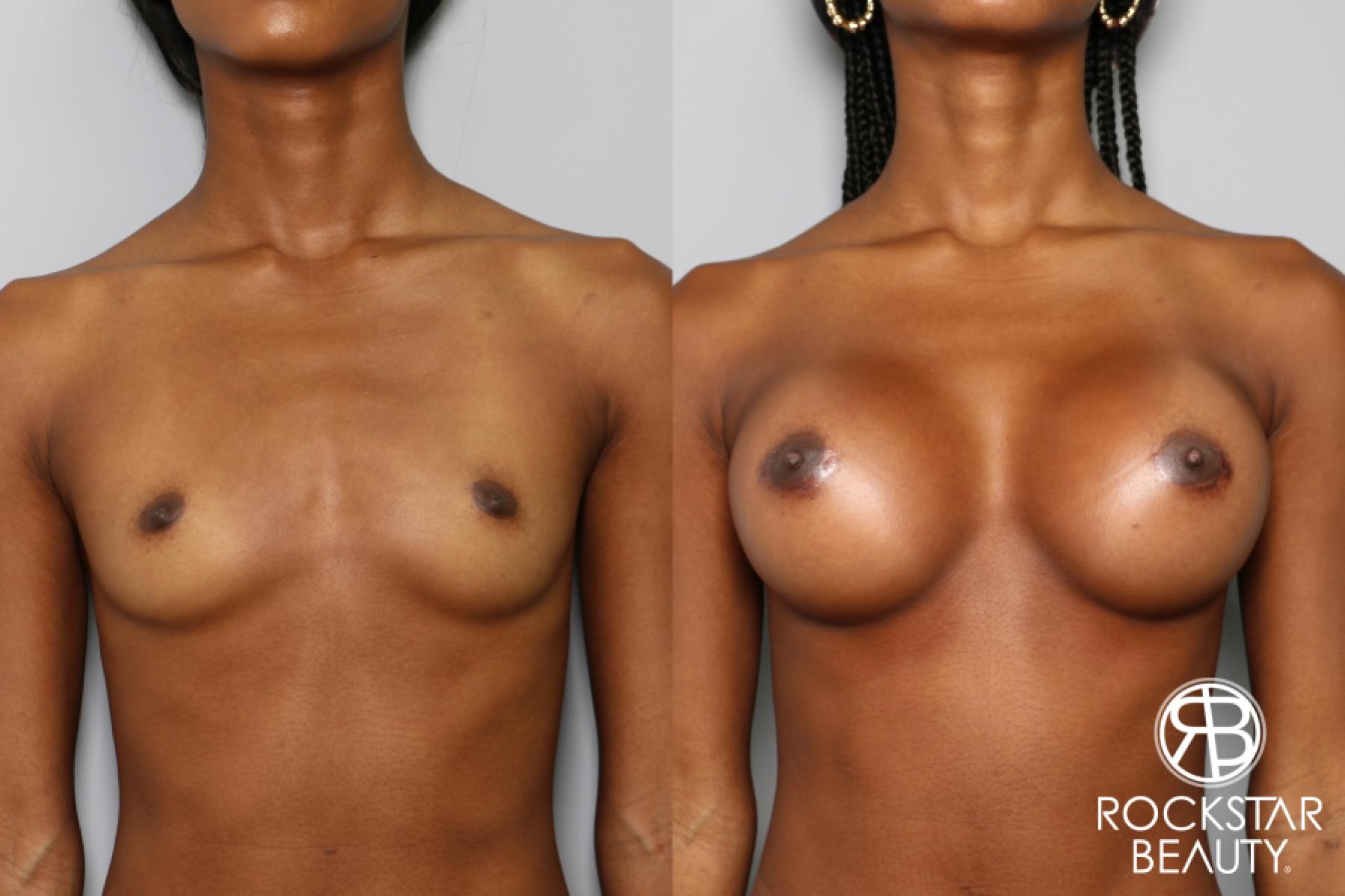 Breast Augmentation: Patient 26 - Before and After 1