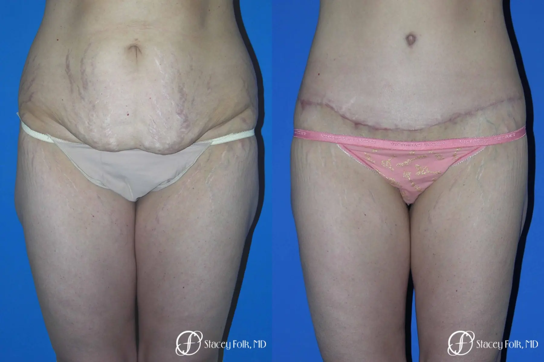 Body Lift Before and After Pictures Case 11523, Denver, CO