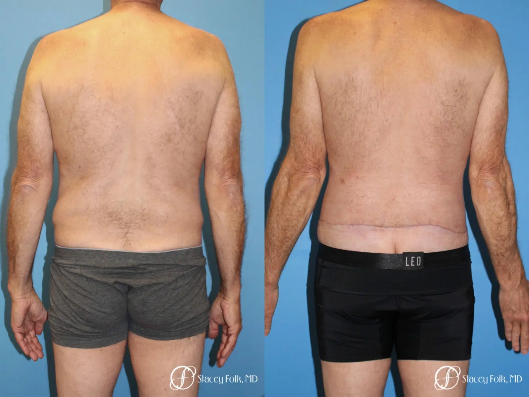 Body Lift Before & After Gallery: Patient 9