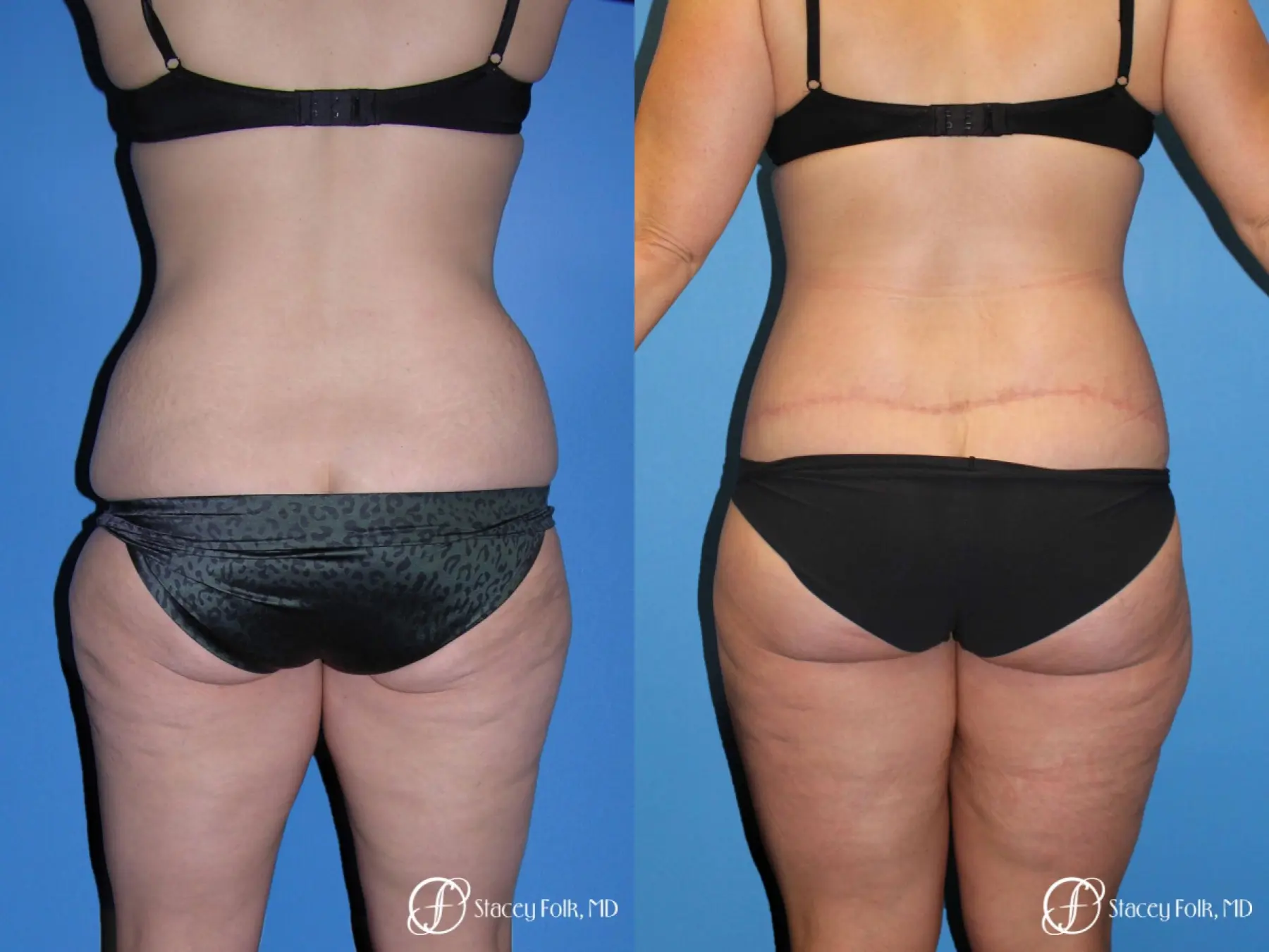 Body Lift Before & After Gallery: Patient 6