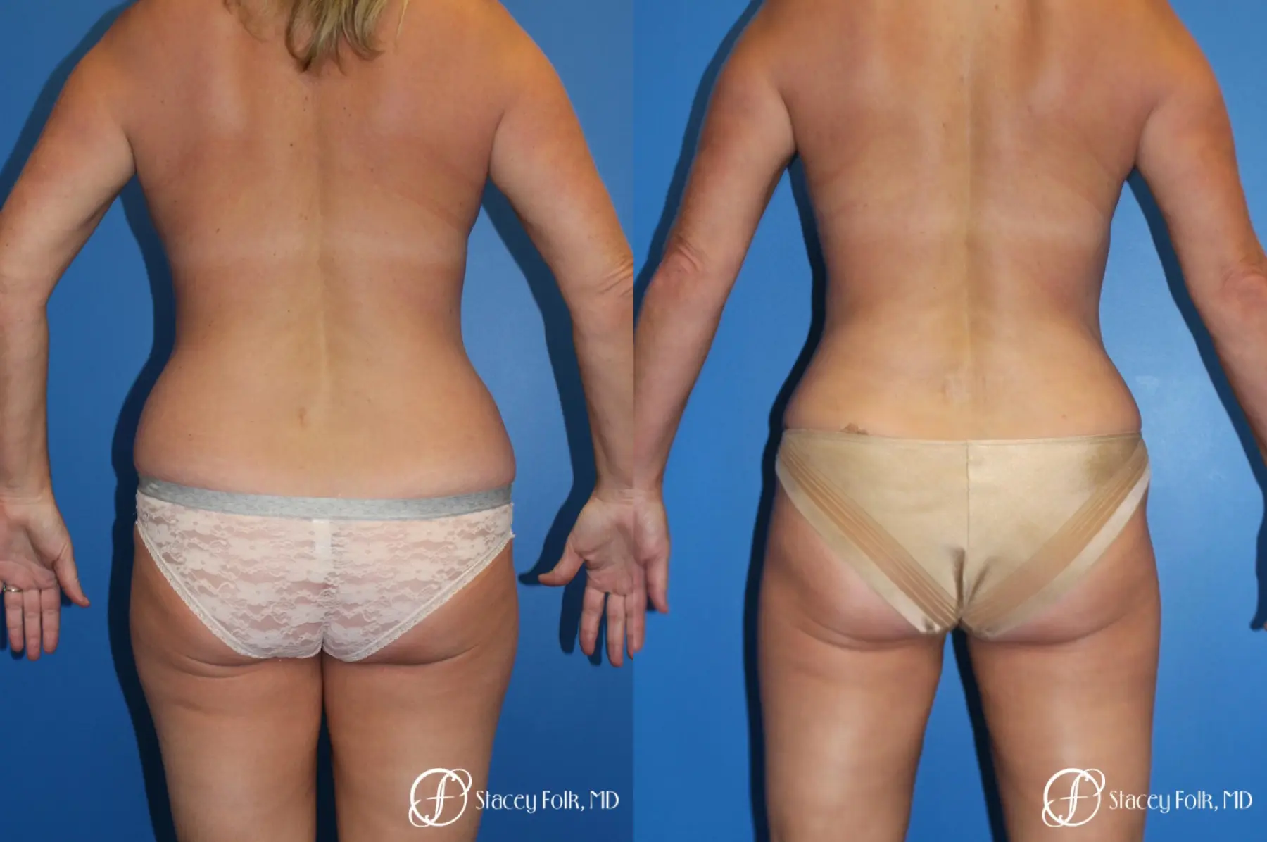 Liposuction Before & After Gallery: Patient 3