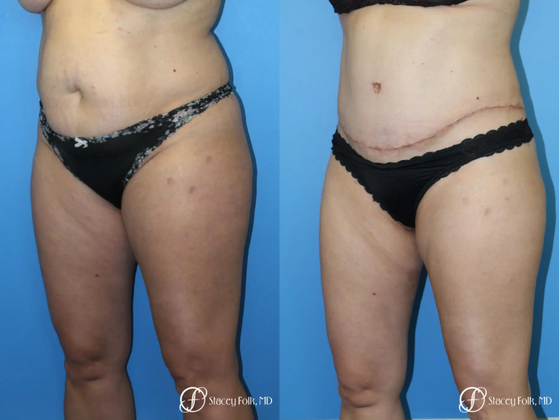 Liposuction, Tummy Tuck, Before and After Pictures