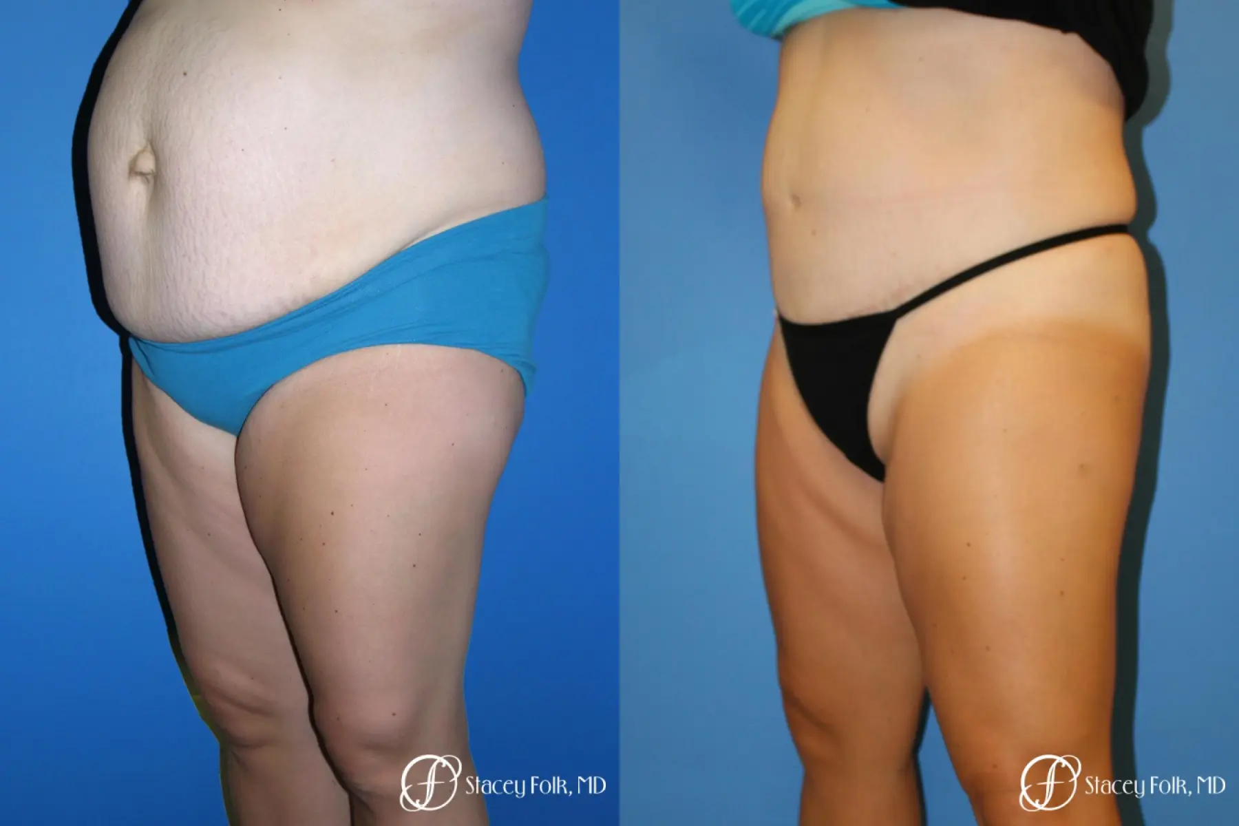 Tummy Tuck Before & After Gallery: Patient 1