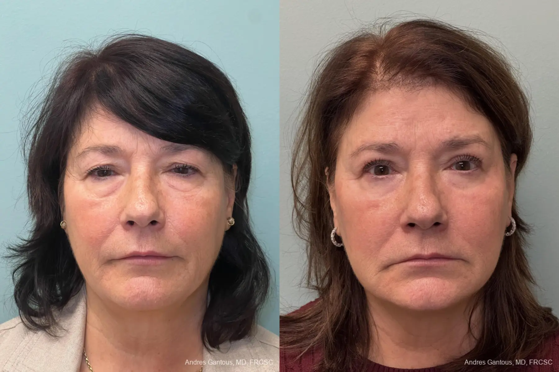 Blepharoplasty: Patient 1 - Before and After  