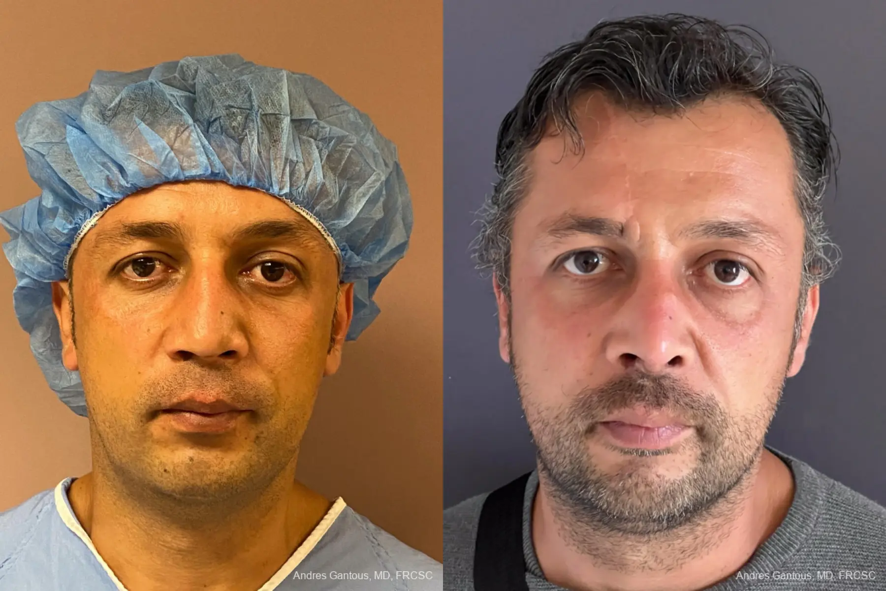 Reconstructive Rhinoplasty: Patient 6 - Before and After  